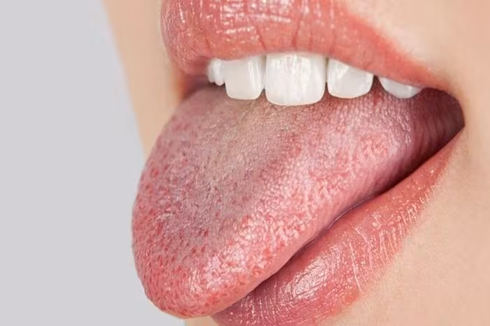 Mảng trắng lan rộng, đau rát miệng lưỡi là dấu hiệu bệnh gì?
